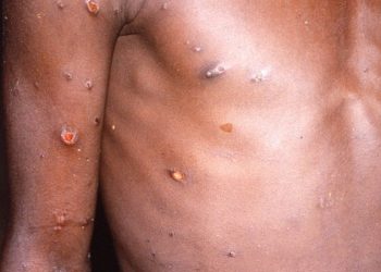 Monkeypox