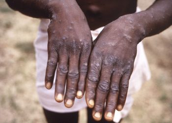 Monkeypox